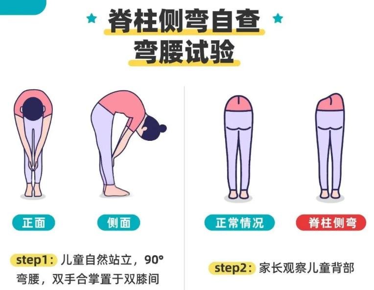 脊柱側(cè)彎與自查