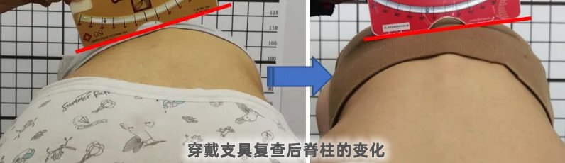 脊柱側(cè)彎支具穿戴3個月要及時復(fù)查