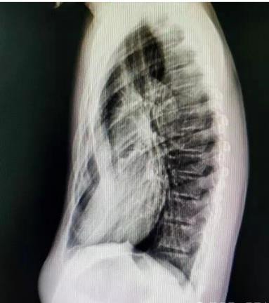 漏斗胸怎么矯正？