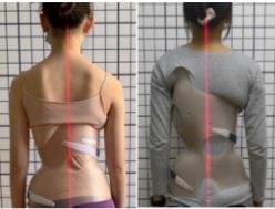 脊柱側(cè)彎矯形器(支具)  