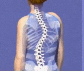 成人脊柱側彎怎么辦？