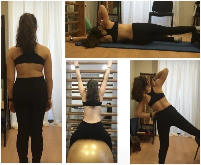 成人脊柱側彎怎么辦？